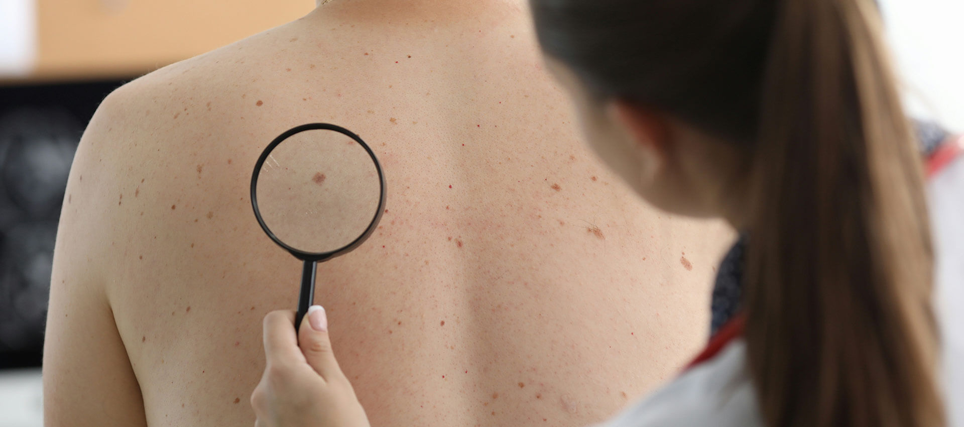 A healthcare professional examines a mole on a patient's back using a magnifying glass in a clinical setting.
