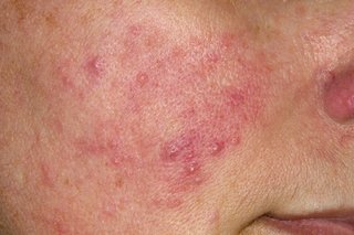A close-up of a person's cheek, displaying red acne or rash with inflamed bumps on the skin. The area is visibly affected, suggesting a possible skin condition in progress.