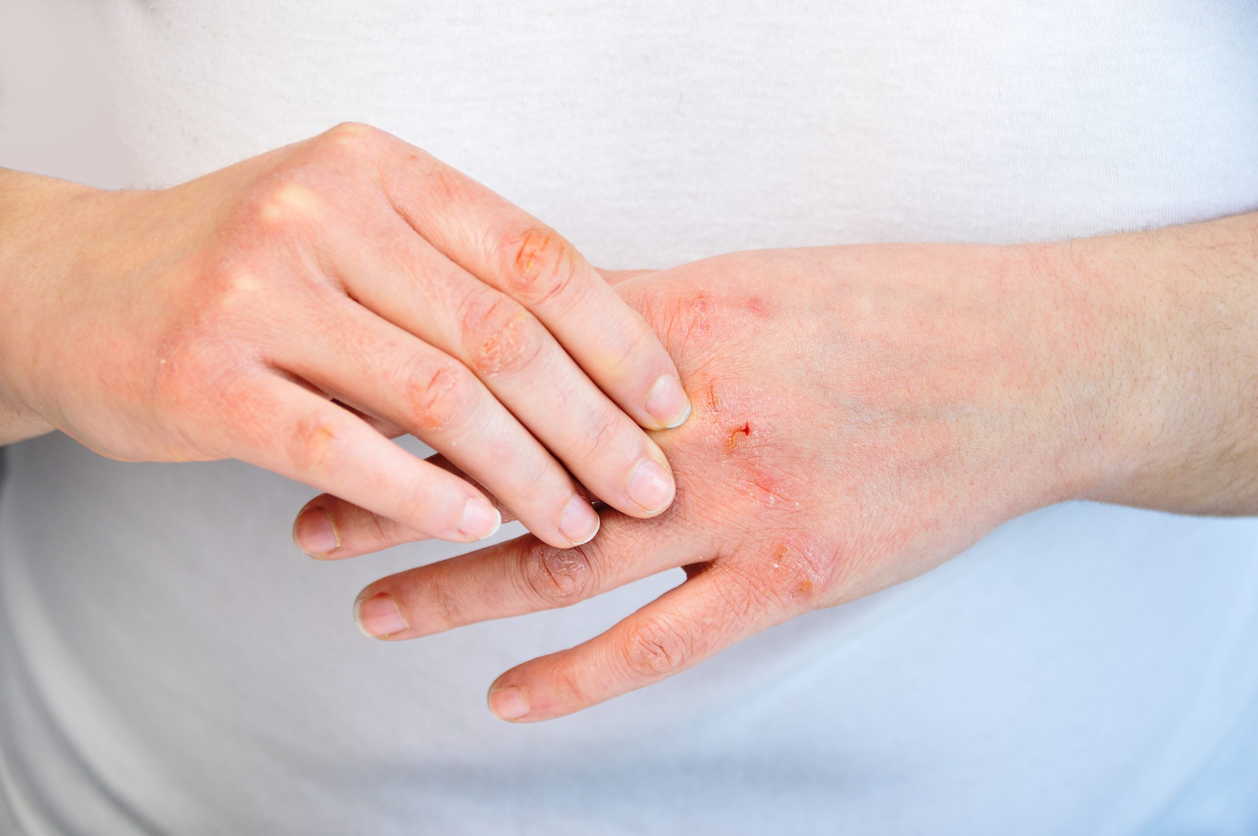 Hands with red, irritated skin are shown, one hand gently rubbing lotion onto the affected areas. The background is a plain white shirt, emphasizing the focus on skin care.