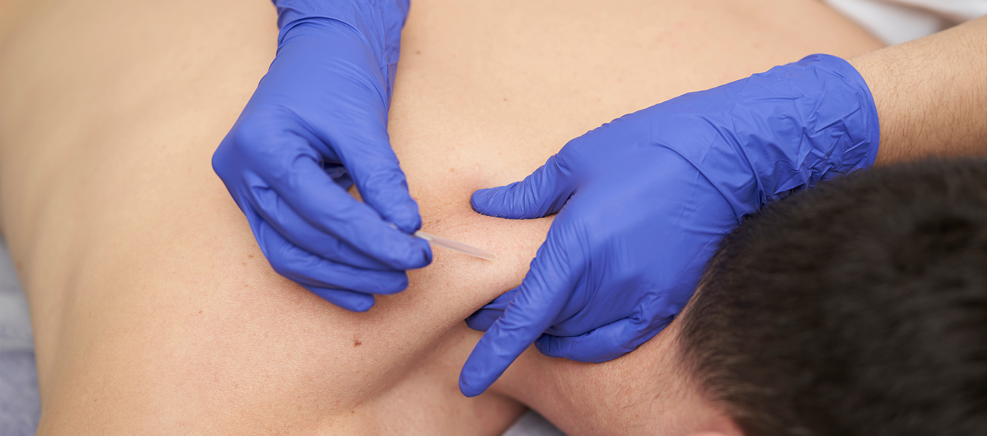 A person's back receives acupuncture treatment, administered by gloved hands inserting needles. The setting appears clinical, focusing on therapy for physical health. No text is present.