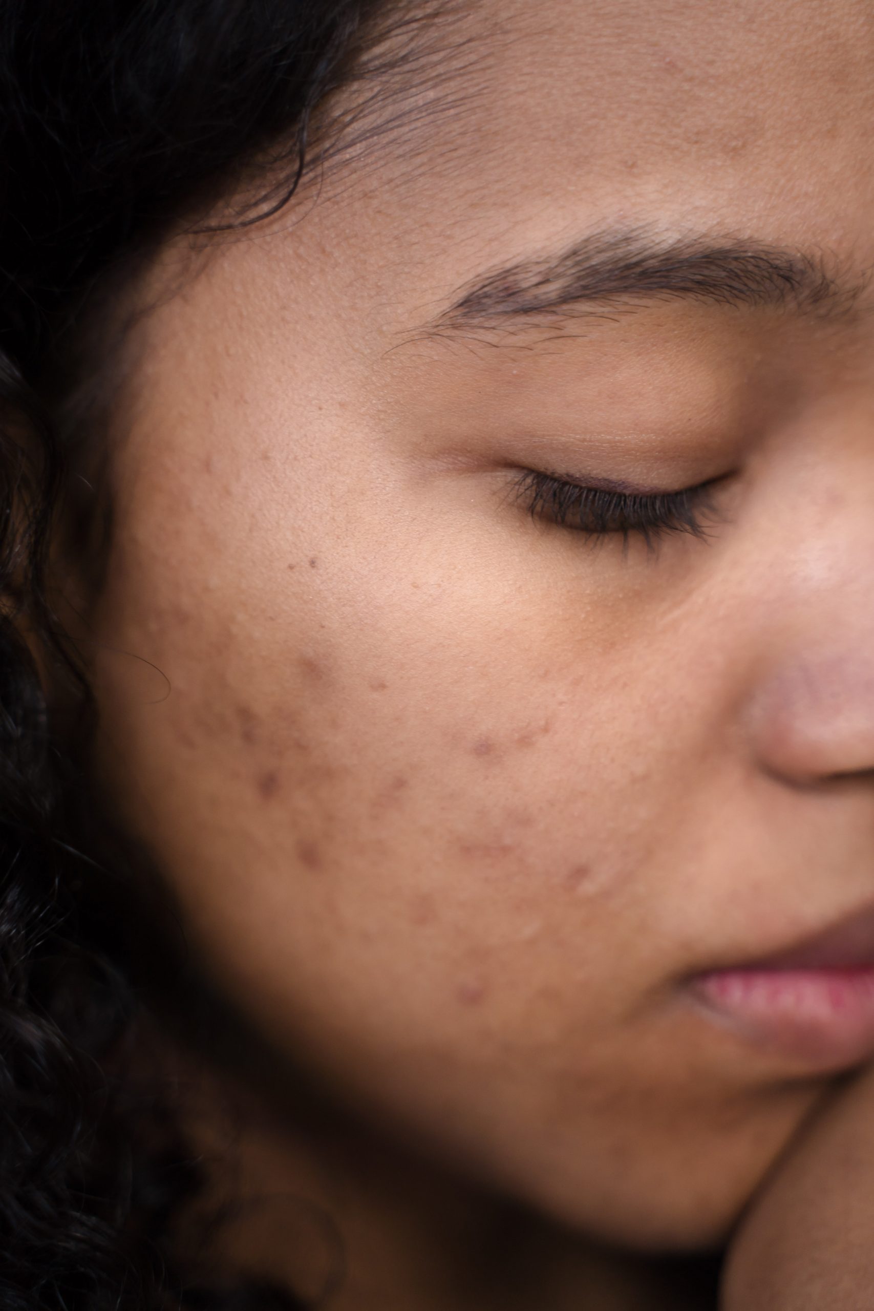 Close-up of a person's face with closed eyes and visible acne marks on the cheek. The focus is on the skin texture, highlighting natural imperfections.