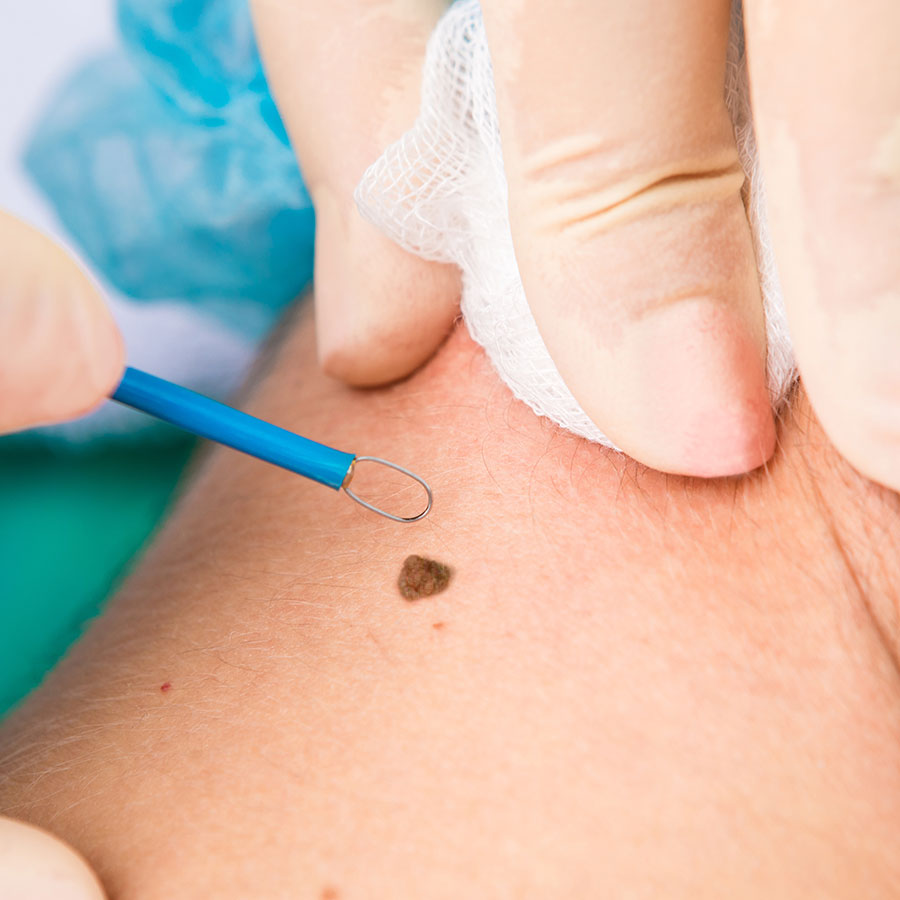 Gloved hands hold a blue medical instrument, removing a mole from skin, with gauze in the background.