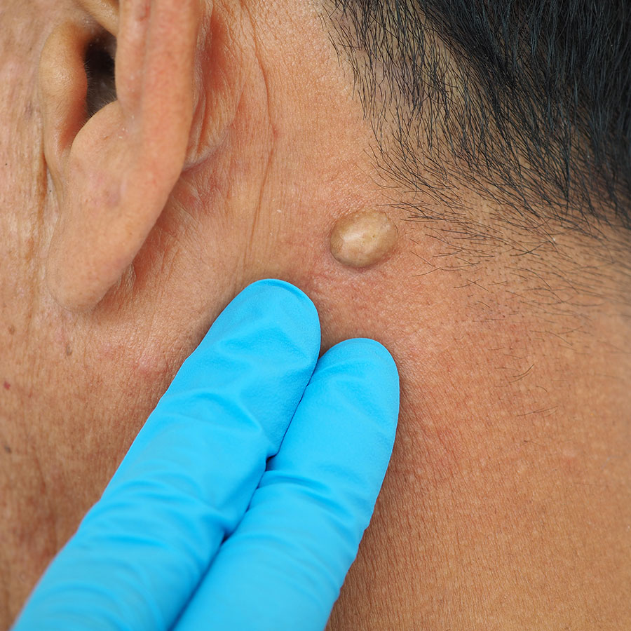 Gloved fingers gently examine a skin lesion behind a person's ear. The person has short, dark hair, highlighting a raised, circular mole on the skin.