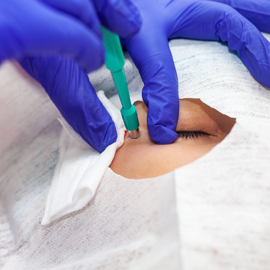 Gloved hands perform a skin procedure on a patient’s face using a green medical tool, in a clinical setting with the patient covered by a sterile drape.