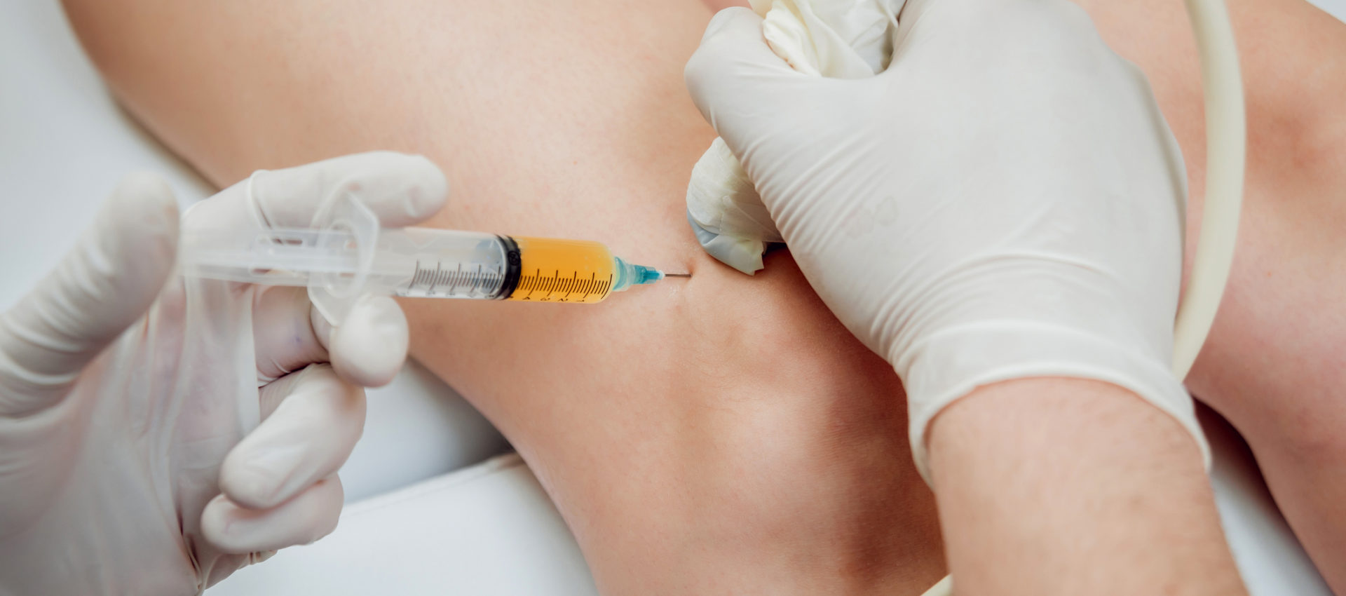 Ultrasound-guided platelet-rich plasma injection of the knee